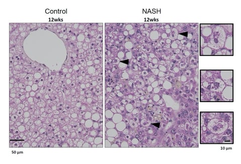 hepatocytes ballooning 