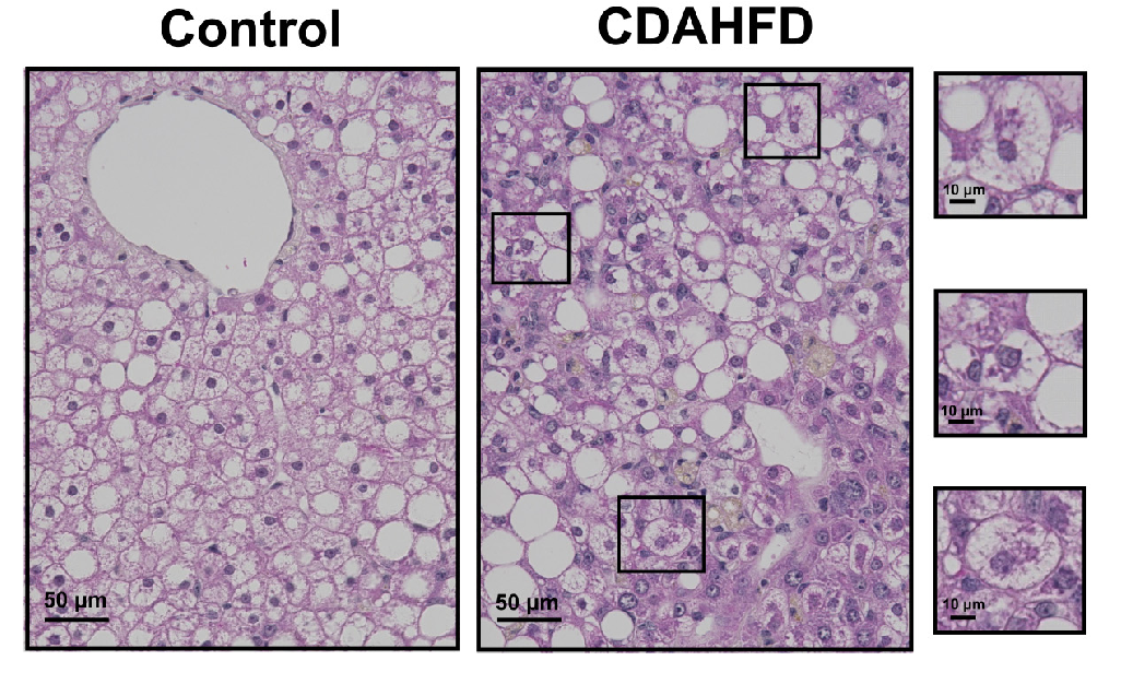 H&E Staining of Human Hepatocyte Ballooning